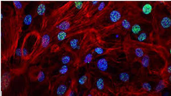 کاربرد سلول‌های بنیادی در درمان دیستروفی عضلانی