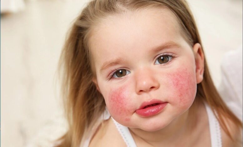 حساسیت زدایی از آلرژی بادام زمینی در کودکان با چسب پوستی