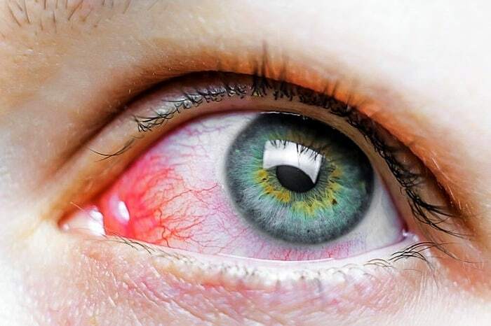 درمان التهاب و اضمحلال شبکیه چشم با روشهای نوین درمان التهاب و اضمحلال شبکیه چشم با روشهای نوین