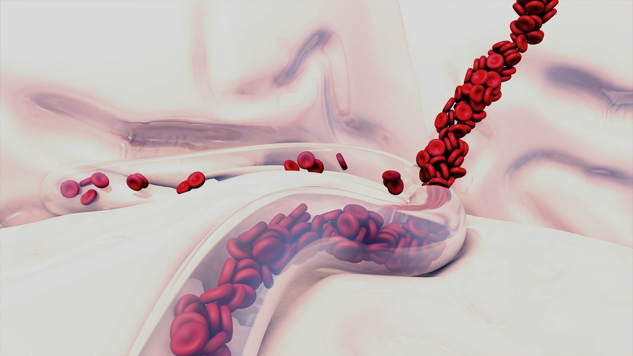 کاهش مرگ و میر در اثر خونریزی داخلی با یک محصول فناورانه