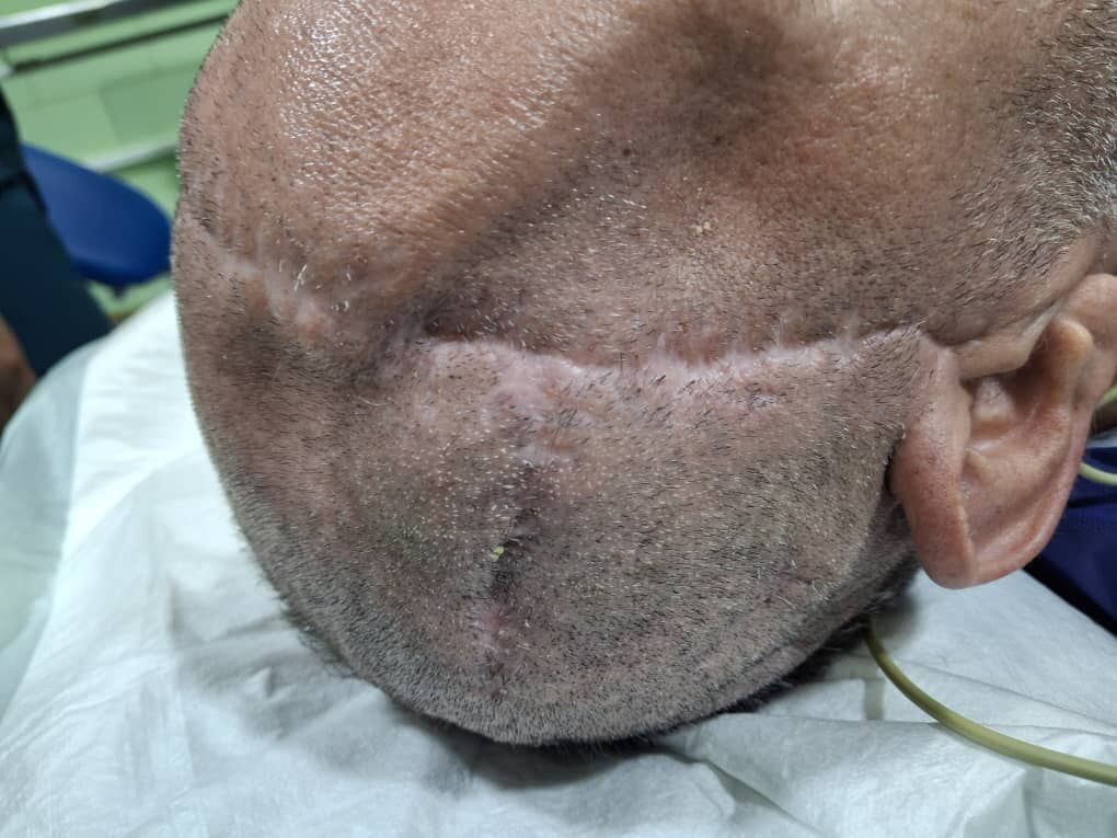 ترمیم استخوان جمجمه با پروتز چاپ شده برای اولین بار در استان اردبیل