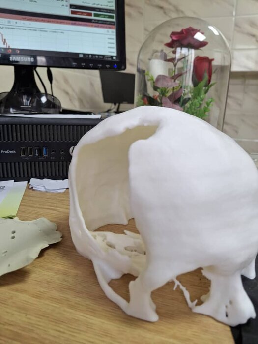 ترمیم استخوان جمجمه با پروتز چاپ شده برای اولین بار در استان اردبیل