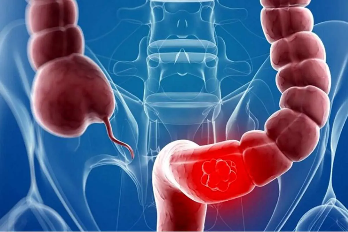 غربالگری سرطان روده بزرگ در تربت‌حیدریه