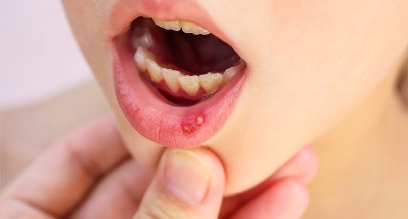 چرا آفت دهان همیشه برمیگردد؟ رازهای پشت این معضل رایج سلامت دهان چرا آفت دهان همیشه برمیگردد؟ رازهای پشت این معضل رایج سلامت دهان