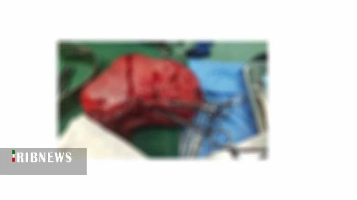 برداشتن توده ۲ کیلویی از شکم خانمی ۴۲ ساله برداشتن توده ۲ کیلویی از شکم خانمی ۴۲ ساله